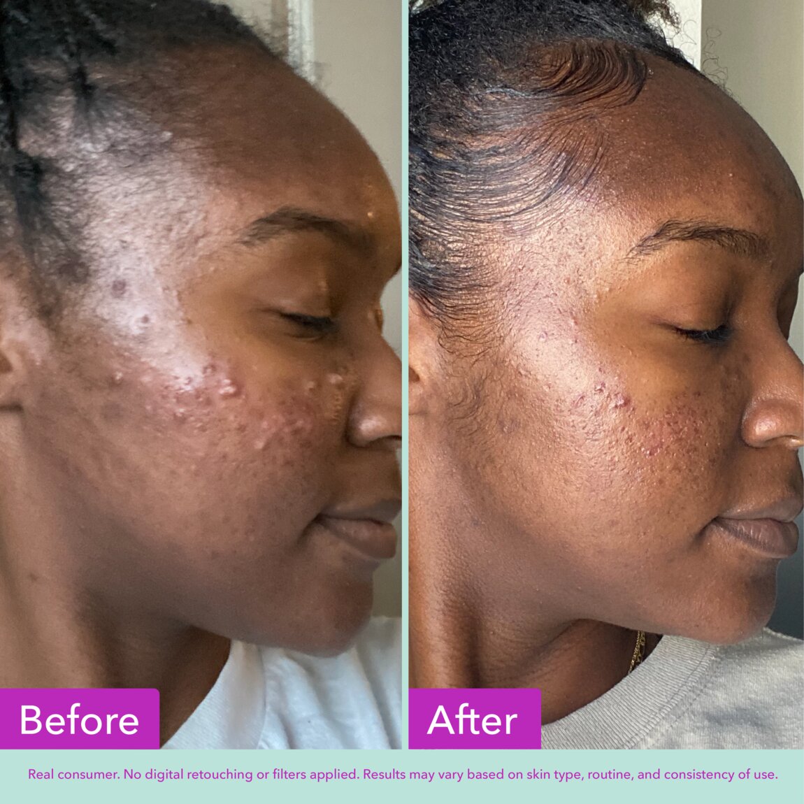 acne-foaming-cleanser-e6 zb_p.jpg