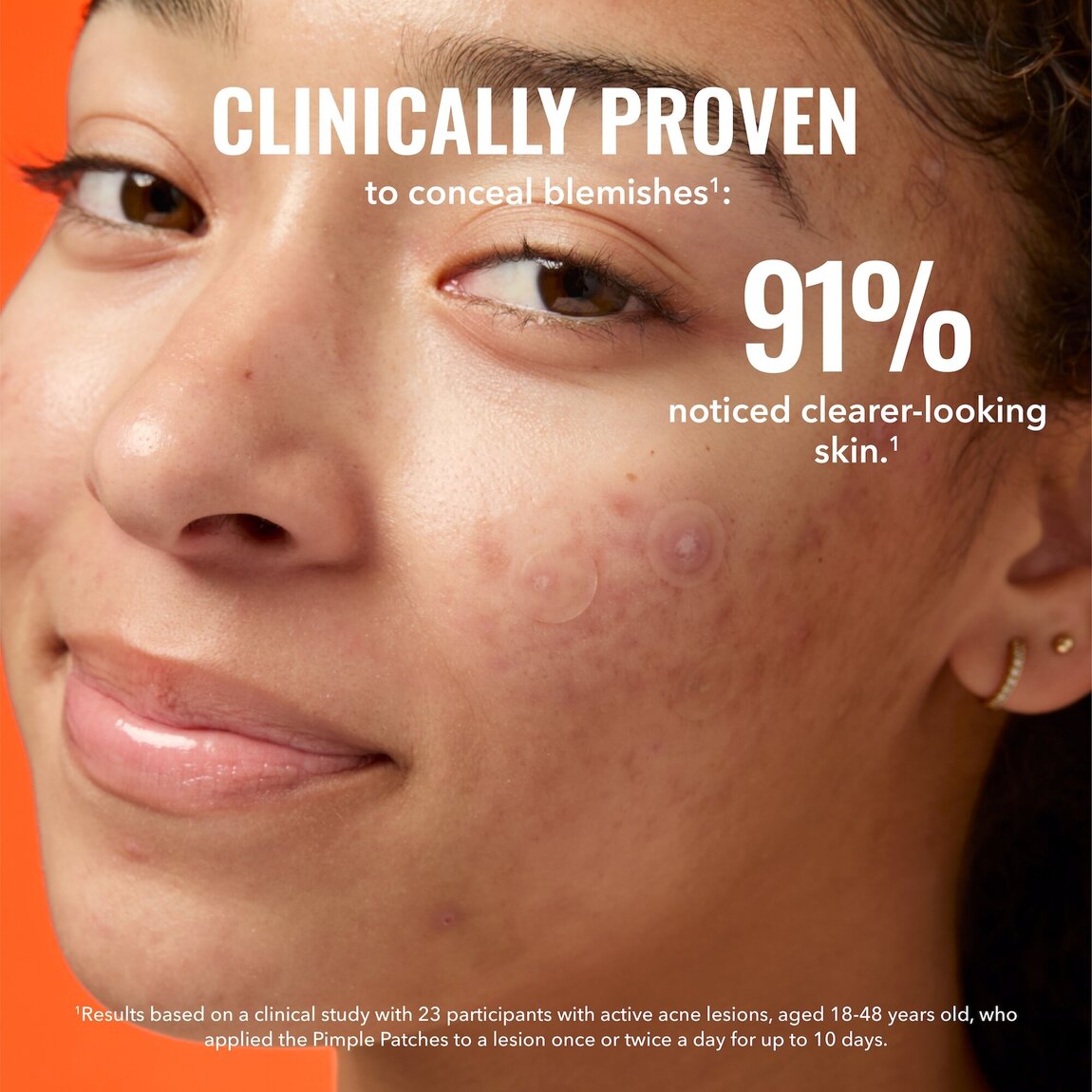 pimple-patches-n1 zb_p.jpg